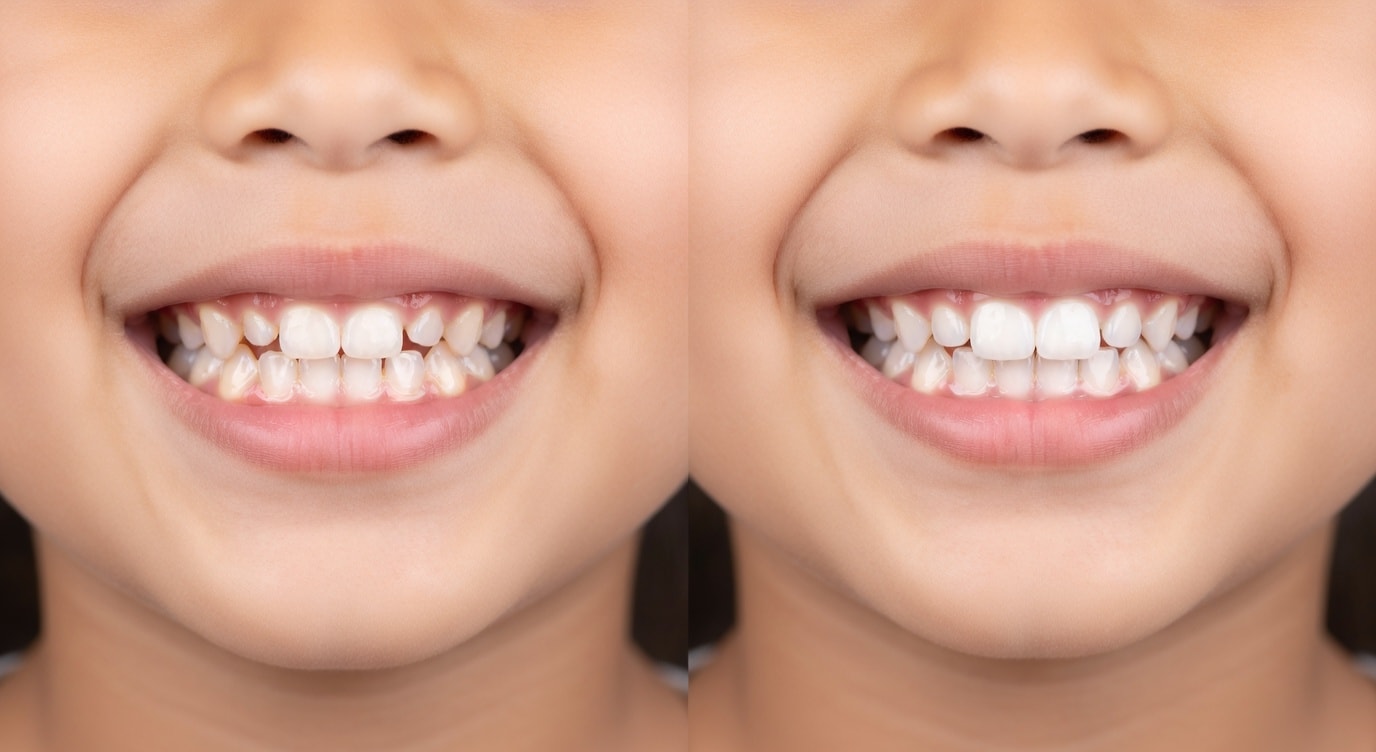 Before Invisalign close-up of mouth and teeth: 7-year-old boy with crowded baby teeth and gaps